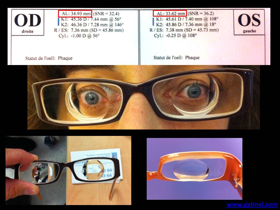 30 miopie acuitatea vizuală online