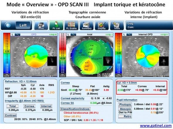 overview Keratocone et implant torique