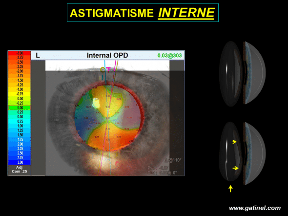 subluxation du cristallin et carte de vergence