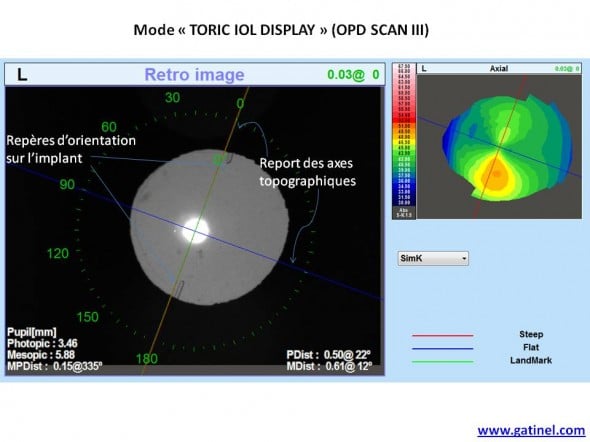 Toric IOL display Nidek OPD SCAN III