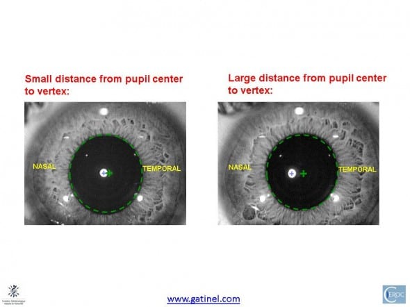 centration with regards to corneal vertex