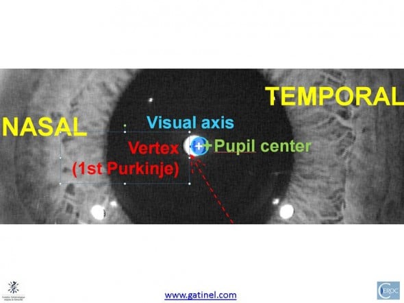 magnified view of the corneal intercepts of the line of sight visual axis corneal vertex