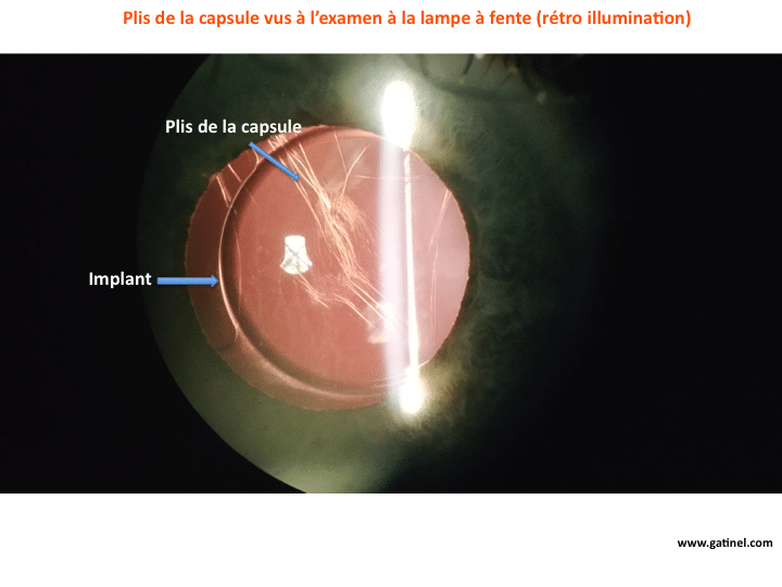 Images Fantomes Vision Double Docteur Damien Gatinel