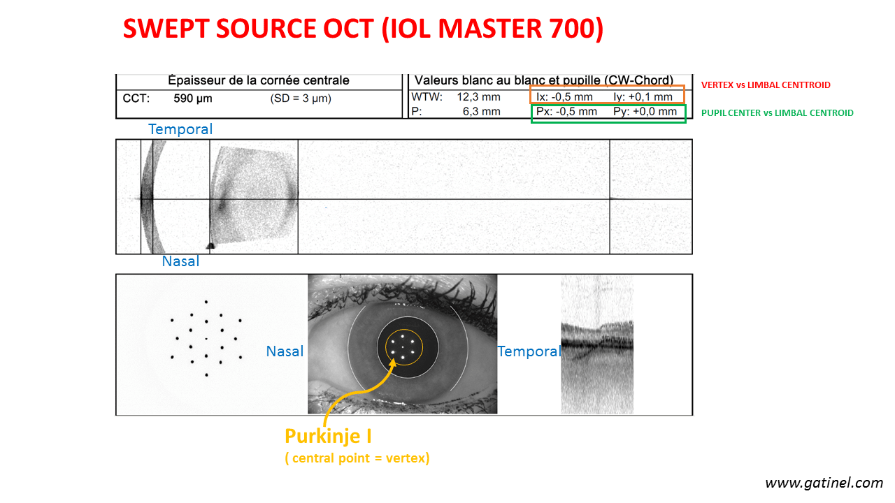 circulatie Australische persoon Inzet Pupillary axis, kappa angle - Docteur Damien Gatinel