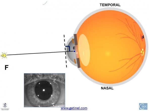 pupillary axis eye