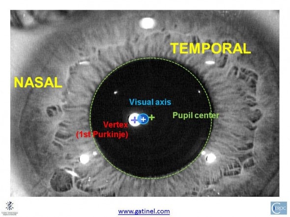 short eye kappa angle line of sight visual axis vertex magnified view