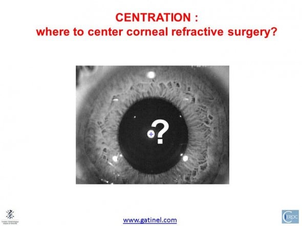 where to center the corneal treatment