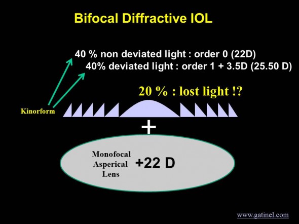 bifocal IOL as kinoform and monofocal and lost energy