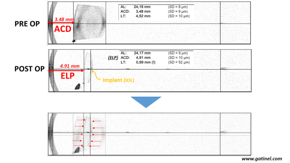 biomtérie ELP