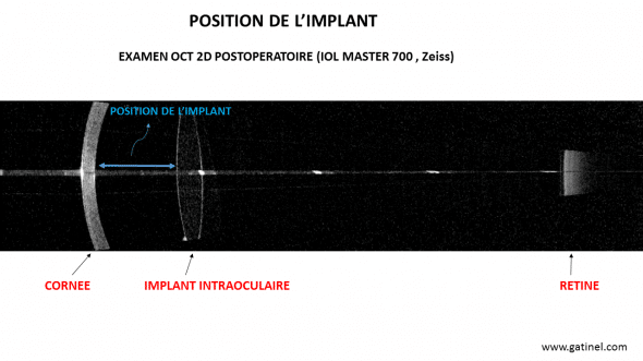 IOL master 700 position implant