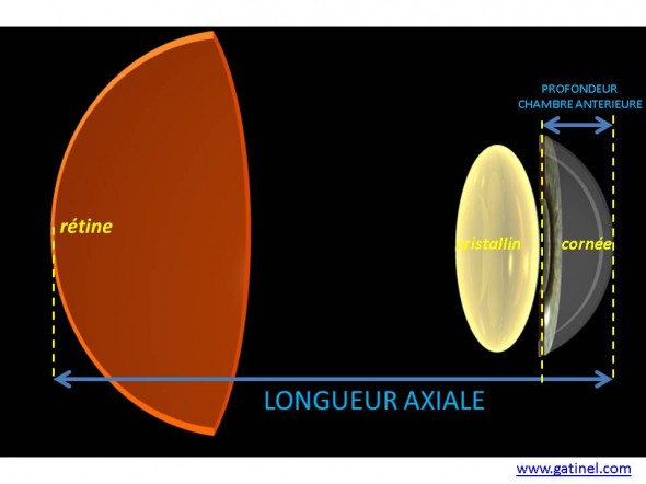 biométrie oculaire paramètres cataracte