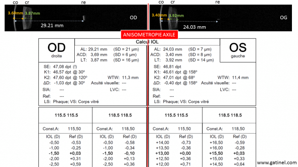 Biométrie (IOL Master 700, Zeiss) chez un patient présentant une anisométropie importante: l'oeil droit est plus myope, car il est plus long de quelques milimètres. Sa chambre antérieure est plus profonde du côté de l'oeil plus long, ce qui laisse présager une position effective finale plus grande (distance cornée / implant) du côté droit que du côté gauche.