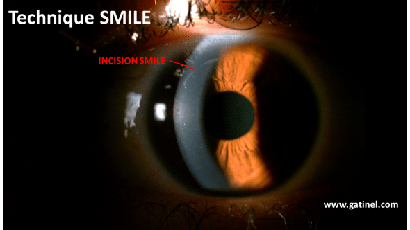 smile incision