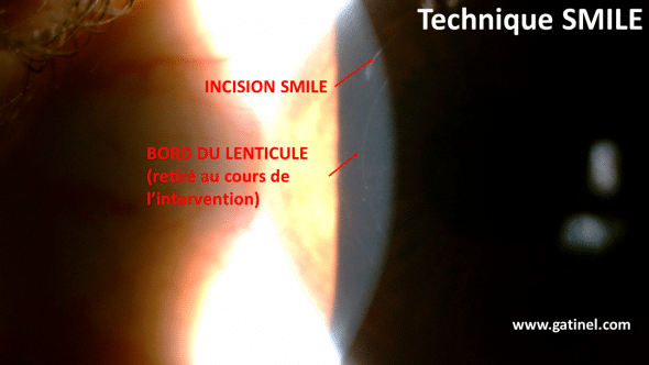 bord du lenticule réfractif smile