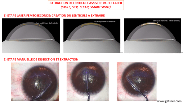 Technique SMILE SILK SMARTSIGHT CLEAR Myopie principes chirurgicaux