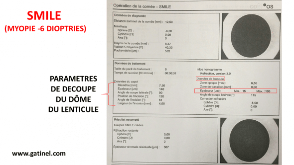 Paramètres découpe lenticule SMILE — correction myopie 6 dioptries zone optique 6,50 mm