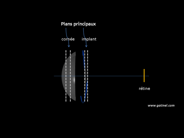 Formule calcul implant utilisant les plan principaux