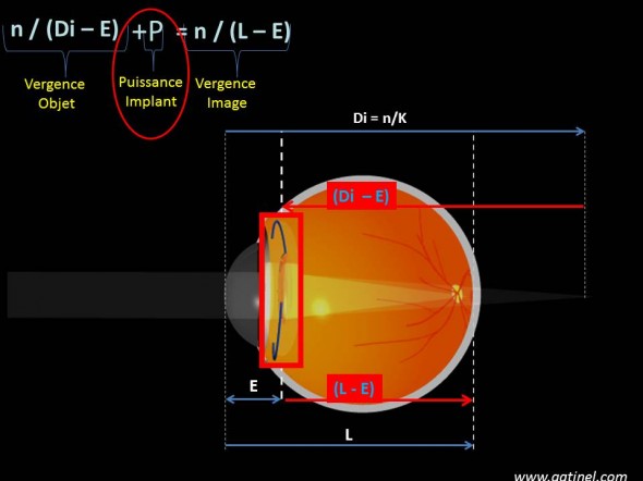 formule de vergence et calcul d'implant