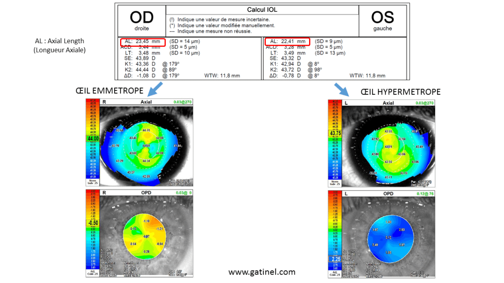 hypermétropie et longueur axiale