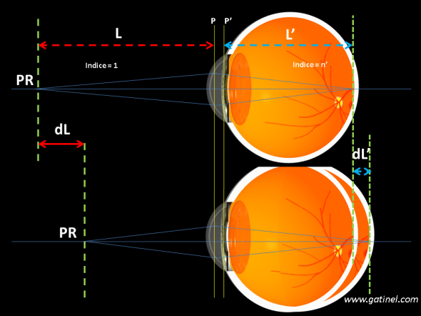 relation entre myopie axile et augmentation de la longueur axiale