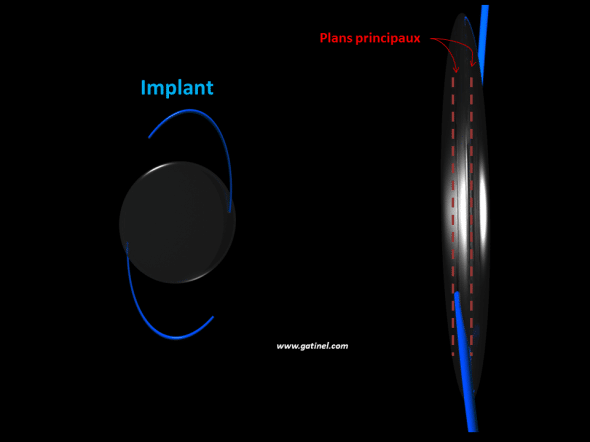 plan principaux des implants