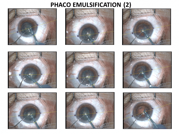 cracking du noyau et fragmentation par phaco émulsification