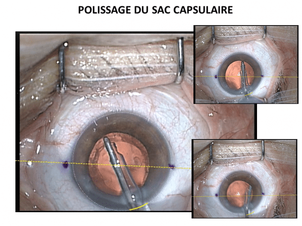 Manoeuvre de polissage interne du sac capsulaire