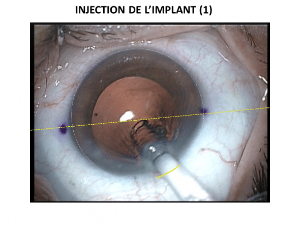 Injection de l'implant par l'incision principale