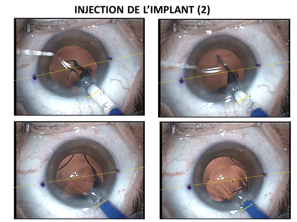 Déploiement de l'implant dans le sac capsulaire