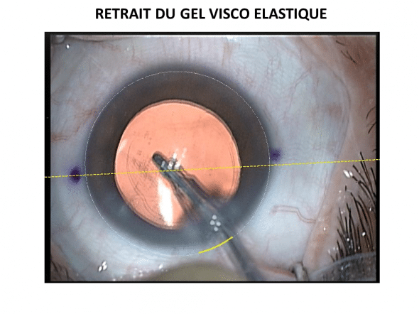 Le gel visco élastique est aspiré