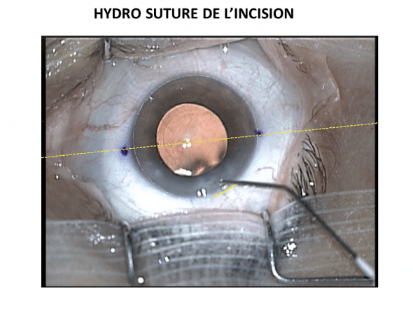 Etanchéification des berges de l'incision par injection