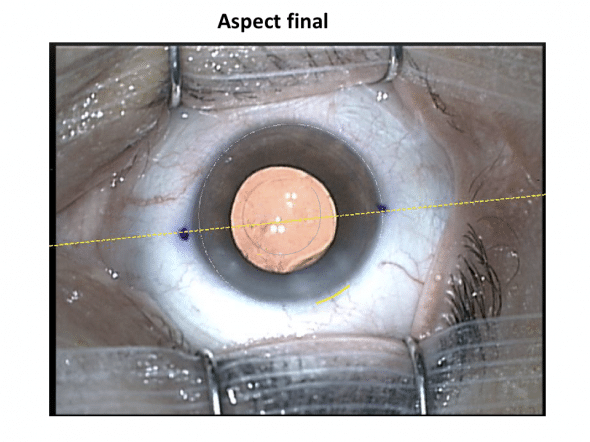 Aspect final de l'intervention de cataracte