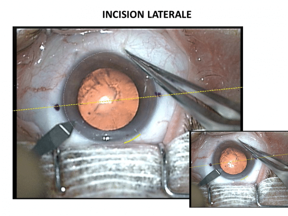 incision latérale ou paracenthèse