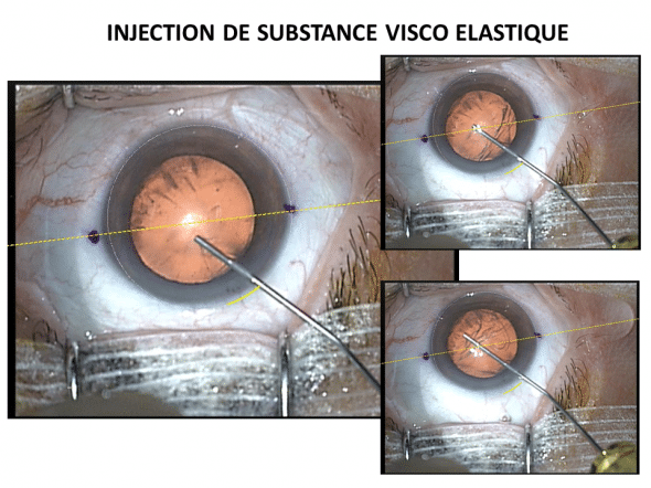 Injenction de substance visco élastique dans la chambre antérieure