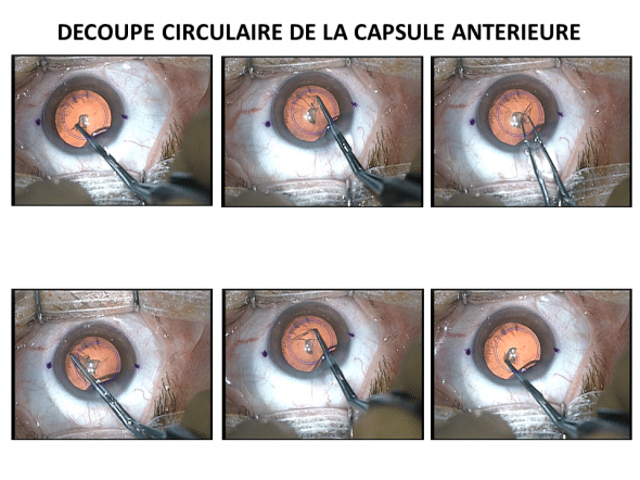 découpe circulaire de la capsule antérieure