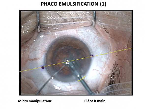 Etape de phaco émulsification