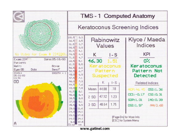 Indices de dépistage du kératocône critères de Rabinowicz Klyce et Maeda