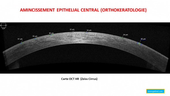 Coupe horizontale de la cornée en OCT haute résolution (Zeiss Cirrus) après port de lentilles Menicon Z Night pour la correction d'une myopie faible. L'appui nocturne avec la lentille provoque une redistribution de la couche épithéliale, qui s'amincit au centre. Cet aplatissement provoque une réduction de la courbure centrale de la cornée (aplatissement relatif, et réduction de la puissance optique du dioptre cornéen).