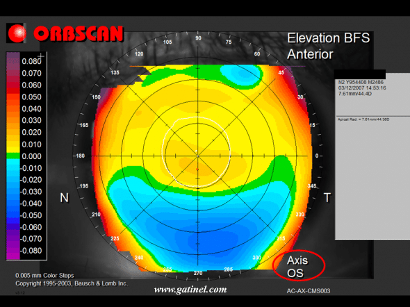asymétrie cornéeenne elevation : utilisation du mode axis