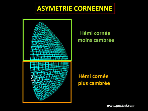 Asymétrie de la cornée