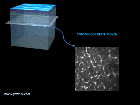 cornée HRT microscopie confocale : aspect du stroma moyen
