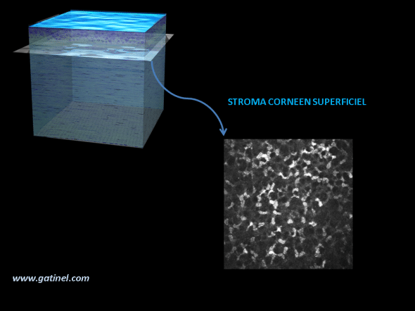 cornée HRT microscopie confocale : aspect du stroma superficiel