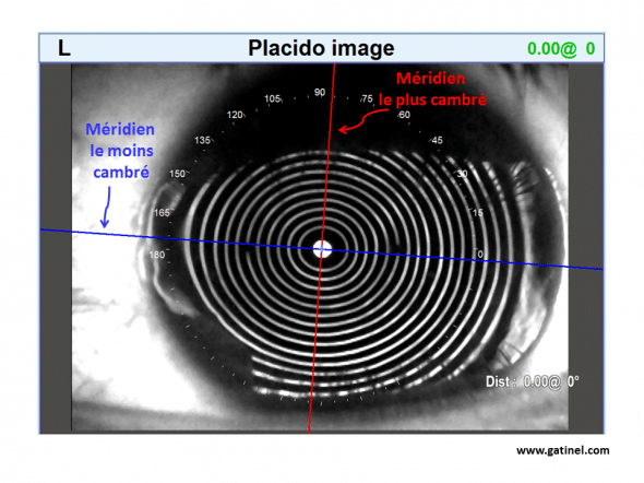 image placido cornée torique astigmatisme direct