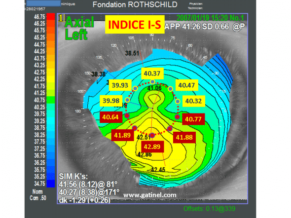 indice I-S pour le dépistage du kératocône