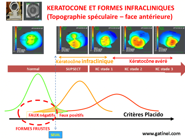 keratocone infra clinique forme frustes et suspectes