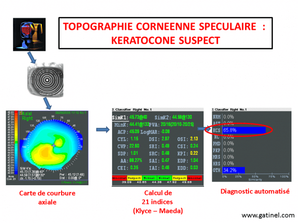 forme suspecte (kératocône infraclinique)