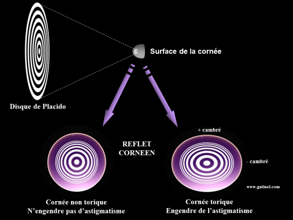 toricité cornéenne obtenue par le reflet spéculaire en topographie