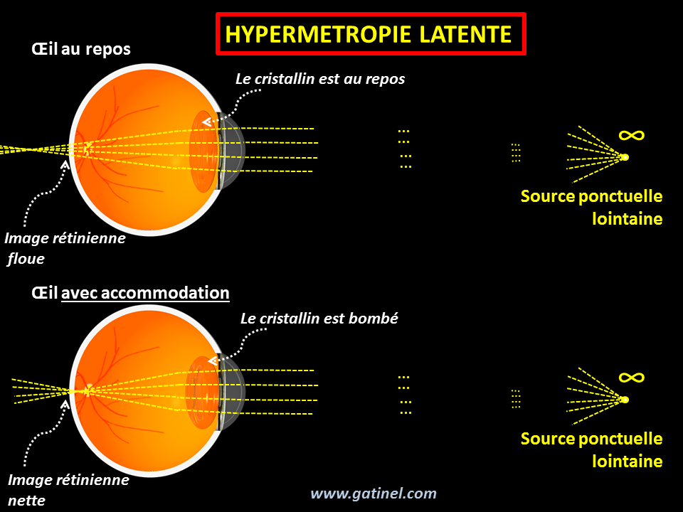 metode de hipermetropie