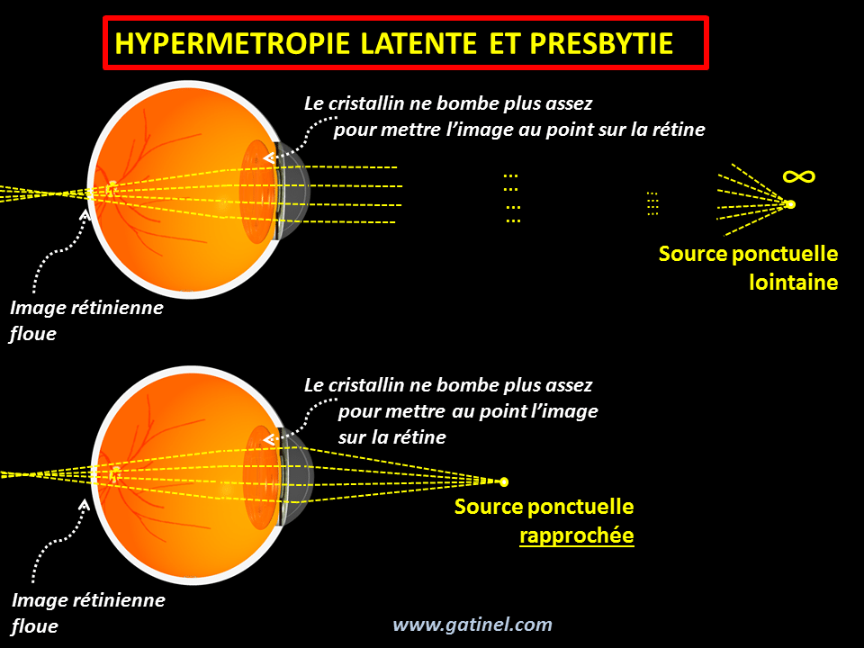 Lunettes Progressives Myopie Presbytie Verres Progressifs