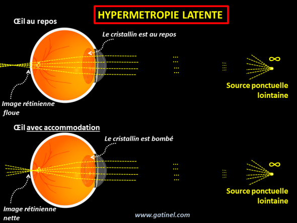 hypermétropie latente compensée avant la presbytie